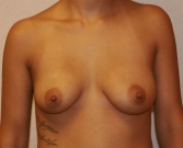 Feel Beautiful - Breast Augmentation San Diego Case 47 - Before Photo